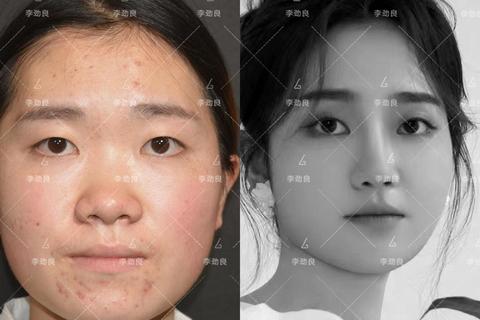为什么有的人没有鼻梁？揭秘先天因素与科学矫正方案