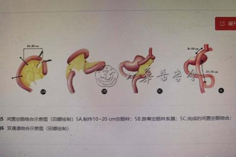 胃部手术模拟挑战:外科医生的虚拟训练营 胃部手术模拟挑战:外科医生的虚拟训练营