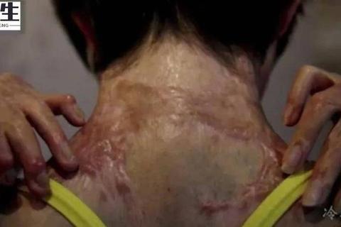 硫酸为什么能毁容？解析腐蚀机制与科学防护方案
