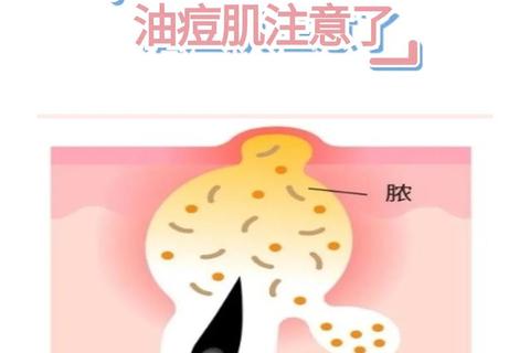 痘力全开-指尖解压大作战：精准爆破痘痘挑战赛