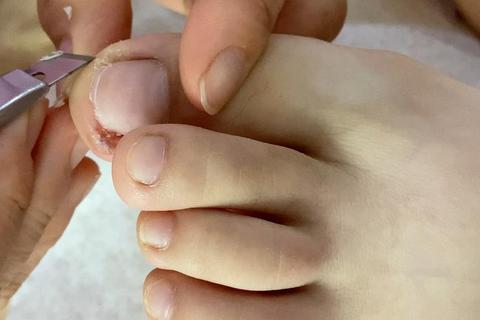脚趾甲多久可以长出来？生长缓慢有妙招，三步护理加速恢复