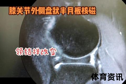 膝盖核磁共振检查范围解析：韧带_半月板_软骨损伤评估