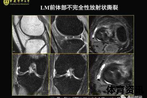 膝盖核磁共振检查范围解析：韧带_半月板_软骨损伤评估