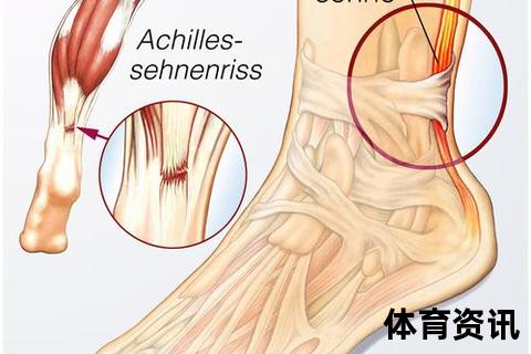 跟腱：连接小腿与足跟的核心肌腱
