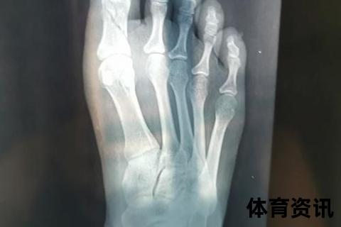 脚趾骨折亲历者讲述_钻心疼痛与行动受限的真实感受