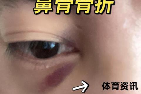 鼻梁骨骨折的伤情分类与外伤类型解析